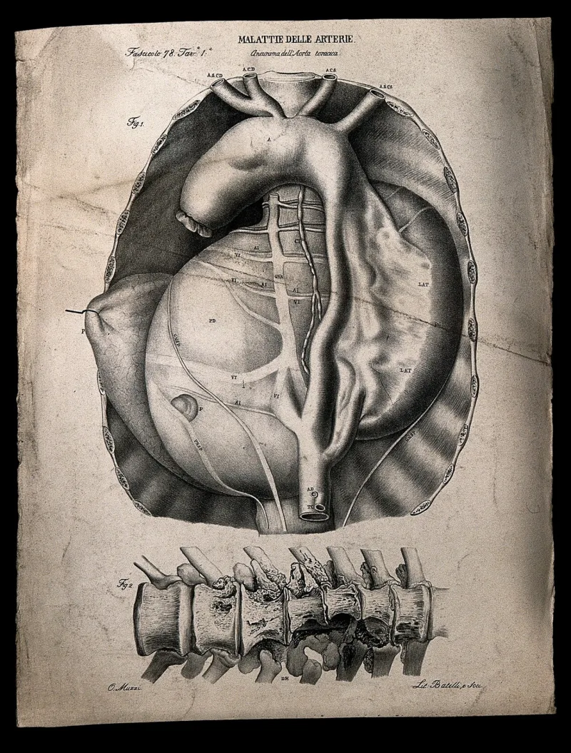 A nineteenth-century medical plate of a damaged aorta, showing the vessel the hadith describes