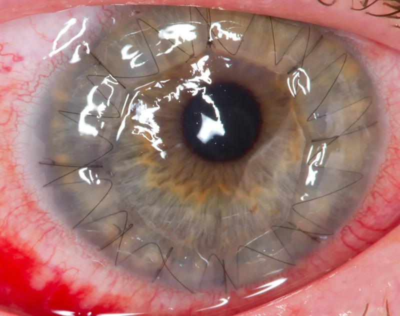 A human eye one day after a cornea transplant, the sutures still visible