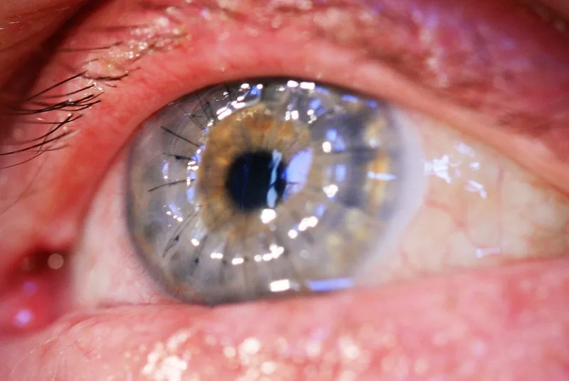 An eye two weeks after a corneal graft; such transplants were refused between 1967 and 1980
