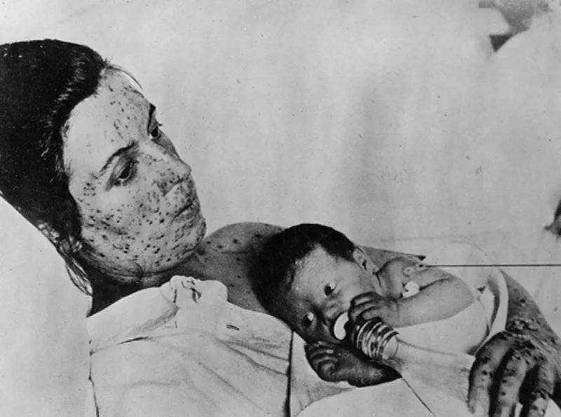 A woman with smallpox beside her vaccinated infant, from a US military medical collection